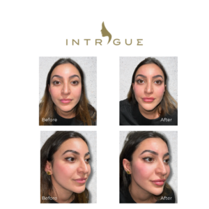 Intrigue Cosmetic Clinic liquid face lift 