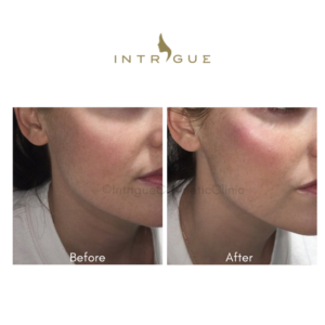 Intrigue Cosmetic Clinic Check filler client 