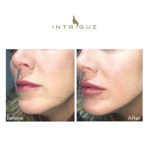 Intrigue Cosmetic Clinic Lip Filler