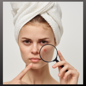 Woman unhappy with blemish outbreaks but here are skincare tips.